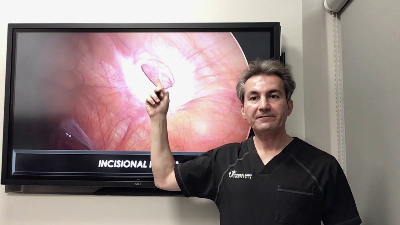 What is an incisional hernia by Dr. Iraniha