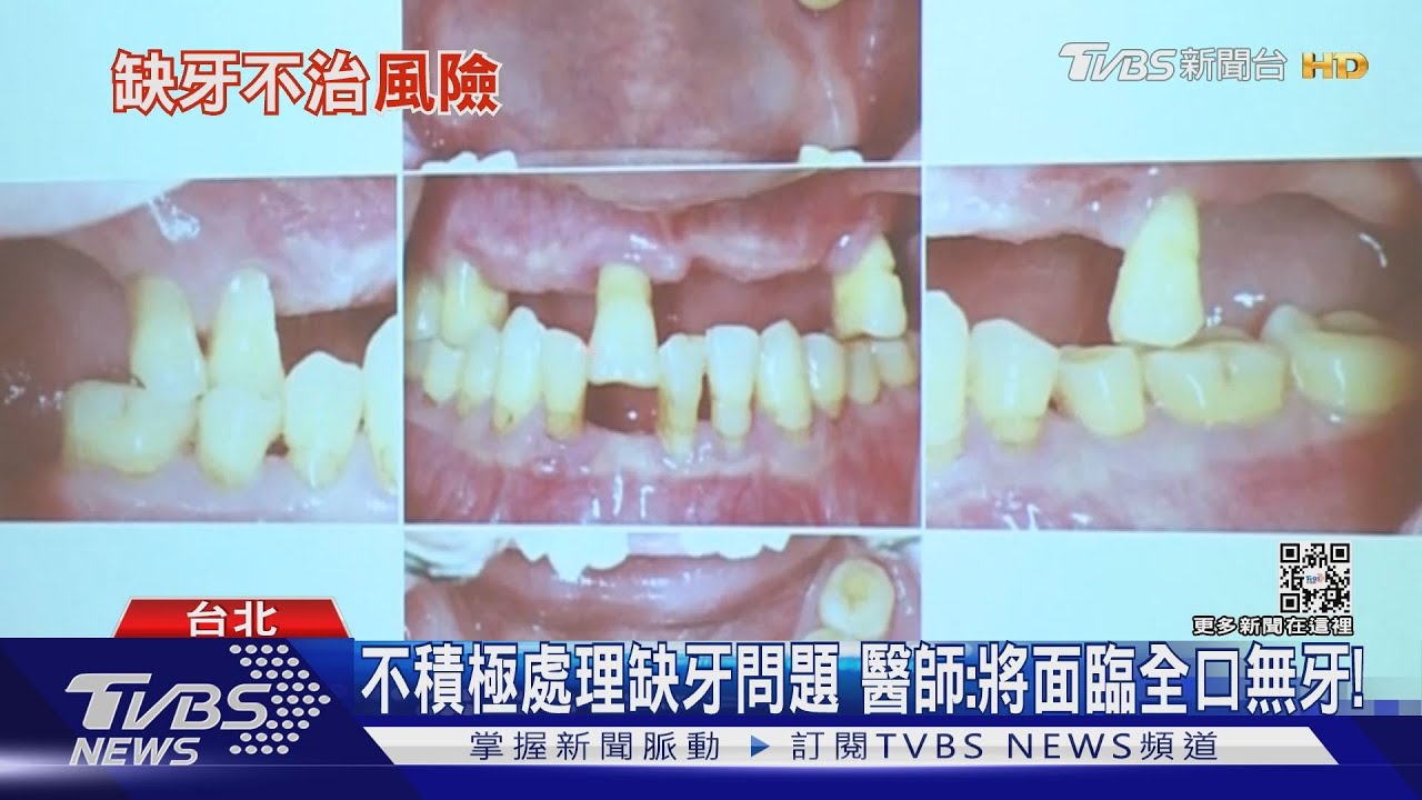 輕忽!缺牙狀況 醫:小心「全口缺牙」關鍵是這件事