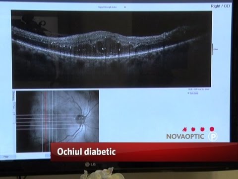 Vindeca miopia remedii populare