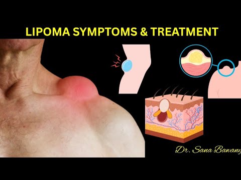 Lipoma Symptoms and Causes || How to Treat Lipoma 