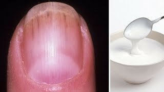 Natural Home Remedies for Black Lines on Nails| How to get rid of ridges in fingernails (In Hindi)