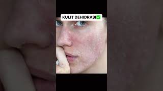 Download lagu PLIS KALAU KALIAN KULITNYA BRUNTUSAN JANGAN LANGSUNG EKSFOLIASI! Belum tentu itu penyebabnya guys😠mp3 Download lagu PLIS KALAU KALIAN KULITNYA BRUNTUSAN JANGAN LANGSUNG EKSFOLIASI! Belum tentu itu penyebabnya guys😠mp3