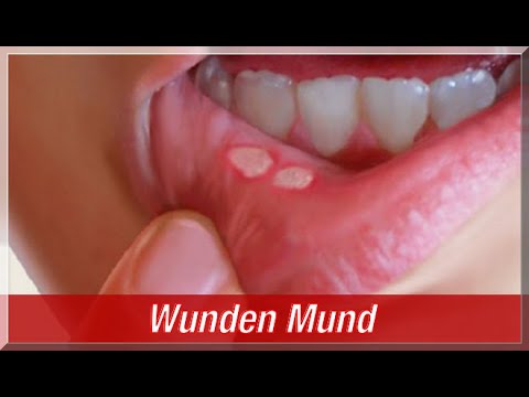 Syndrom Schublade Kniegelenk Video Rückenschmerzen nach Sectio zu tun