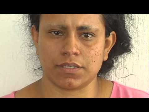 Fernandito recibe prótesis oculares