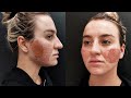 View 16 Fractional Co2 Laser Acne Scars Before After
