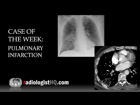 Case of the Week: Pulmonary Infarction (X-ray & CT)