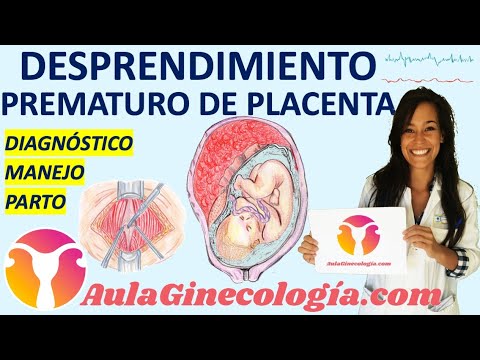 DESPRENDIMIENTO PREMATURO DE PLACENTA NORMO-INSERTA o ABRUPCIO PLACENTAE .-Ginecología y Obstetricia