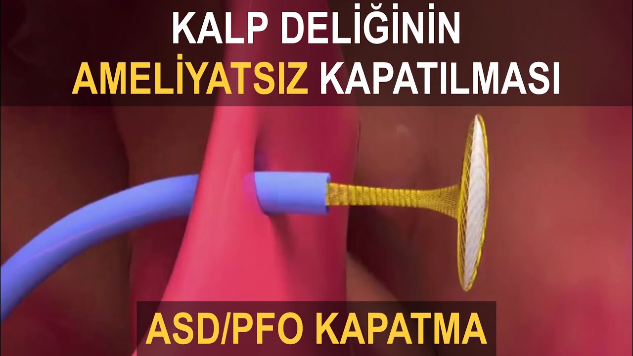 ASD Kapatma