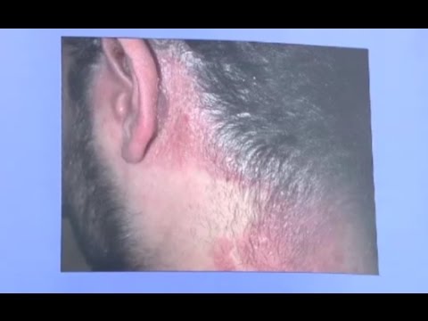 Nano-gel per cura di psoriasi Forte di hilak a bambini a dermatite atopic a