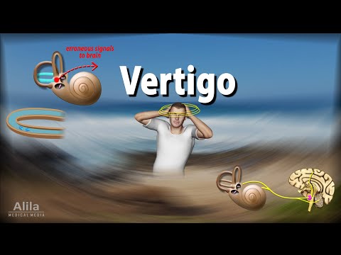 Vertigo: Causes, Pathophysiology and Treatments, Animation