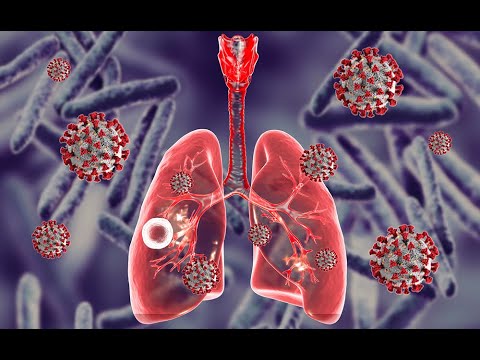 COVID-19 ECHO Session #43: Tuberculosis and the COVID-19 Pandemic: Tackling the challenge