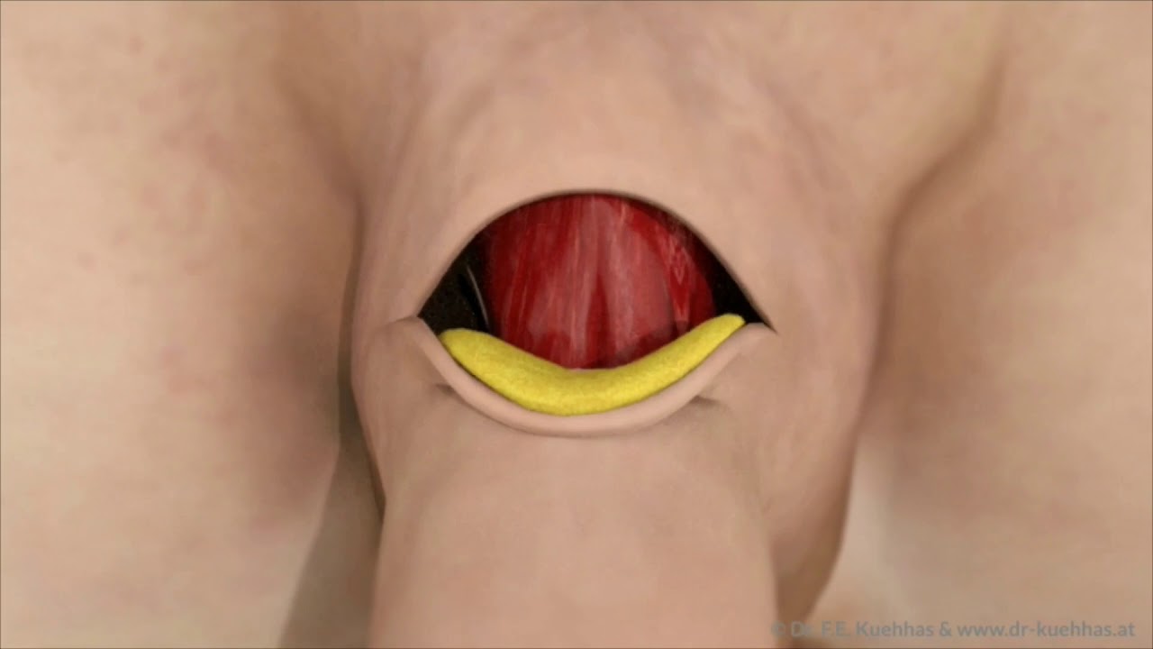 FALLOPLASTICA DI ALLUNGAMENTO - Dr. Francesco De Luca Uro-Andrologo