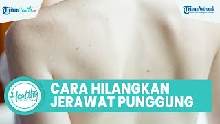 Hilangkan Jerawat Punggung dengan Mudah Tanpa Obat, Ini Langkah Tepat Obati Jerawat hanya di Rumah