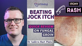 Beating Jock Itch | A Doctors Guide to Tinea Cruris | Fungal Groin Infection