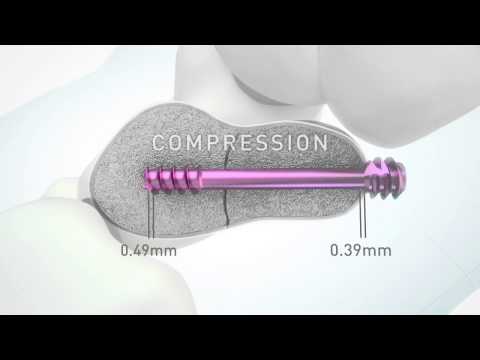 HBS 2  Headless bone screw by KLS Martin