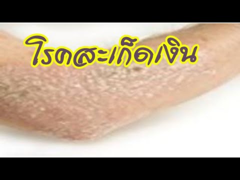 กลากกับความเครียดประสาท ครีมในโรคสะเก็ดเงิน Palmar