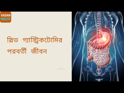 স্লিভ গ্যাস্ট্রিকোমির পরবর্তী জীবন