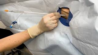 Small bore/Pigtail Catheter Chest Tube Insertion