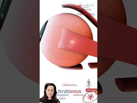 Crossed Eyes Repair 👁️ Strabismus 😏  hypertropia ⚕️ Medical Arts Animation
