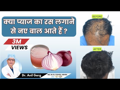, title : 'Does Onion Juice Control Hair Loss and Growth in Hindi - Know The Scientific Reason | India'