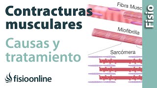 Contractura muscular - Qué es, cómo sucede y cuál es su tratamiento