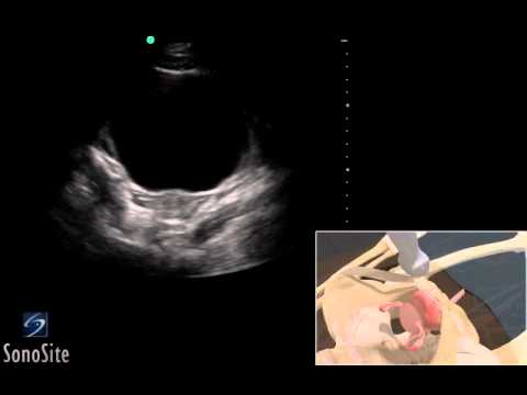 How To: EFAST - Pelvis 3D Video