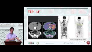 Médecine Nucléaire et Lymphome (Dr A/K. TALBI)