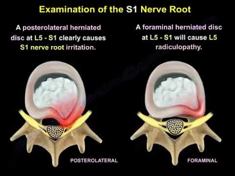 Examination of the S1 Nerve Root: Sensory, Motor, and Reflex Findings – Dr. Nabil Ebraheim