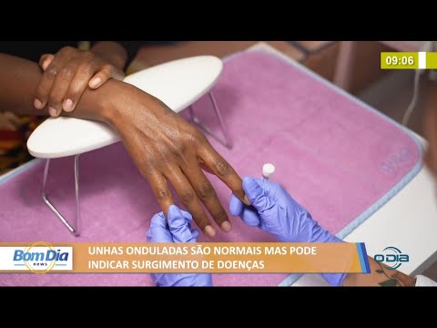 Unhas onduladas são normais mas pode indicar surgimento de doenças 15 07 2021