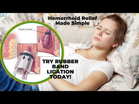Hemorrhoid Relief Made Easy: Discover Rubber Band Ligation!