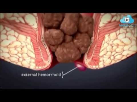 What are the Types of Hemorrhoids? Op.Dr.Kadir Uskuay