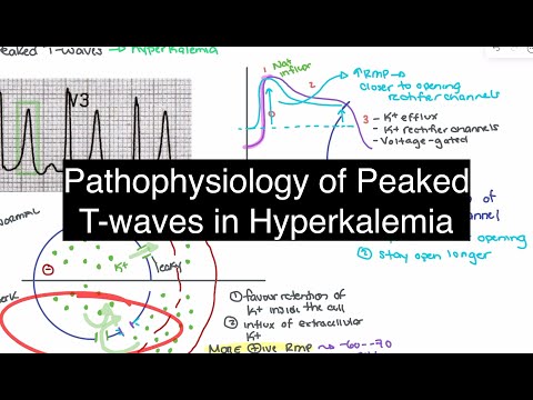 Hyperkalemia Explained: Pathophysiology of Peaked T-Waves