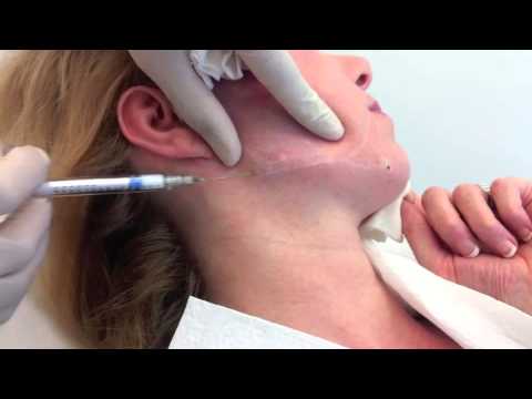 download lagu mp3 mp4 Injection Acide Hyaluronique Paris, download lagu Injection Acide Hyaluronique Paris gratis, unduh video klip Injection Acide Hyaluronique Paris