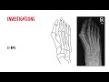 Bunions (Hallux Valgus) – Causes, Symptoms & Treatment Explained