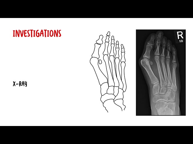 Bunions (Hallux Valgus) – Causes, Symptoms & Treatment Explained