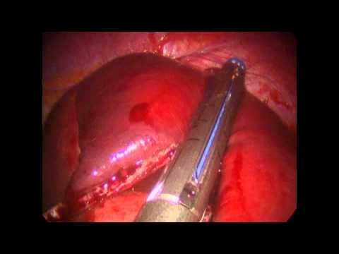 Laparoscopic Partial Splenectomy