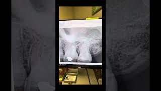 Chemistry is awesome! #dentists #rootcanaltherapy @FlexivoDental 