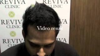 Reviva Clinic Hair transplant result