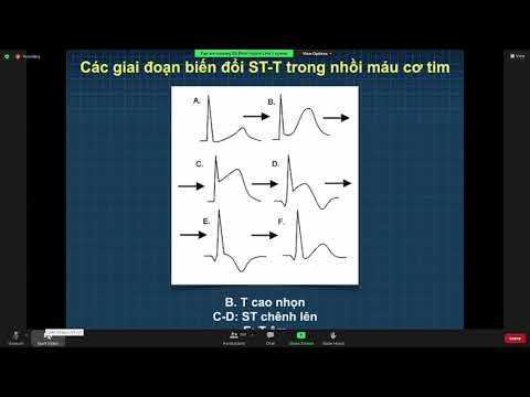 (Lý thuyết) hội chứng vành cấp 16/11/2021