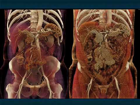 CT Evaluation of Small Bowel Obstruction - Part 3