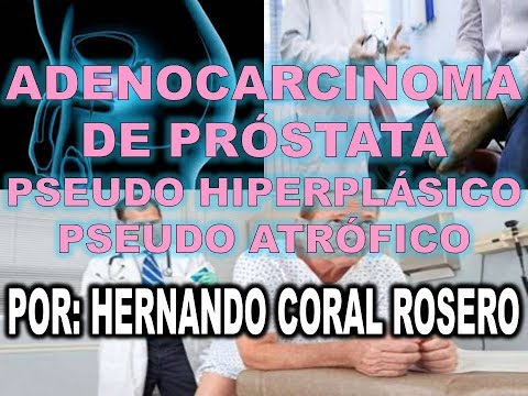 Infiammazione della prostata e del suo trattamento Video della prostata