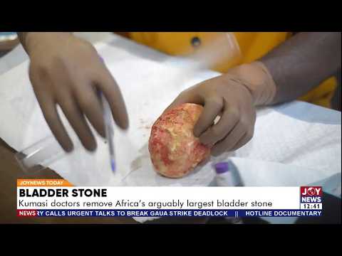 Bladder Stone: Kumasi Doctors remove 880g mass from man after 30 3ears of suffering