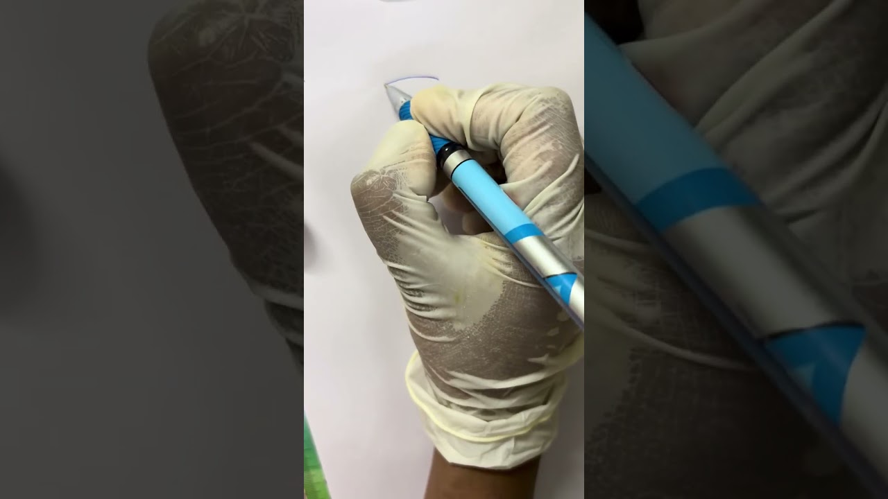 White matter of cerebrum ( brain) , corpus callosum, internal capsule