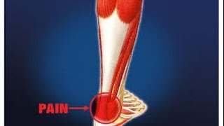 preview picture of video 'Laser Therapy for Achilles Tendonitis New Canaan,Darien & Stamford 203-656-3636'