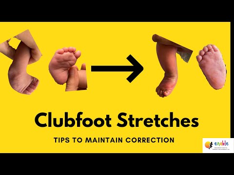 How to do Clubfoot Stretches- Parent information to avoid relapses. Post Ponseti exercises.  #shorts