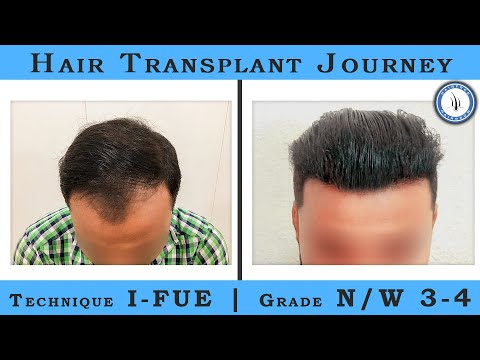 Best Hair Transplant Result Grade N/W 3-4 | By Dr. Jinkal Kunjadiya and team || HFHG Clinic Surat
