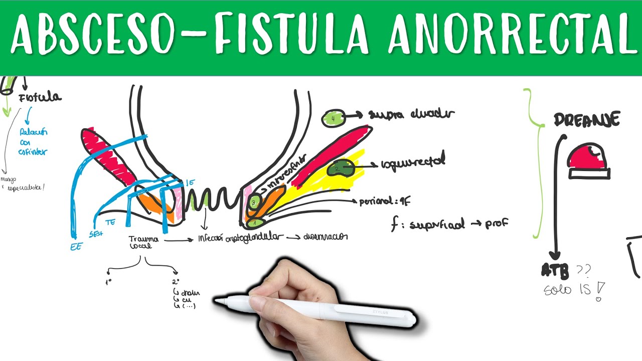 ABSCESO - FISTULA ANORRECTAL #absceso #fistula #anorrectal #isquiorrectal