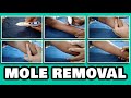 black mole removal on face tamil