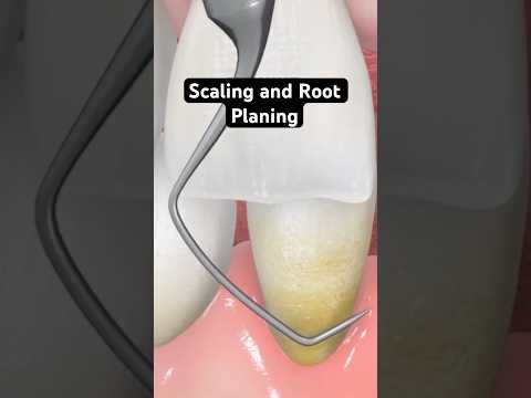 Scaling and root planing (3D Animation)
