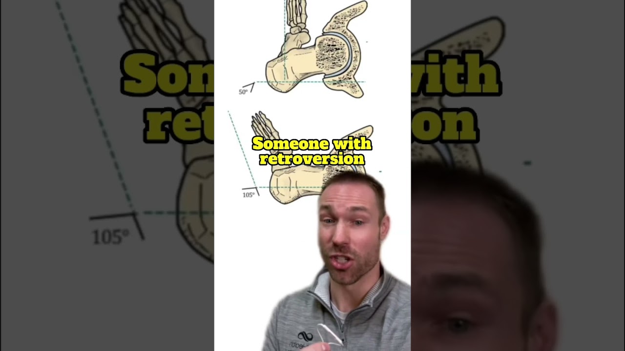 How to Squat For Your Anatomy (Toes Out?)